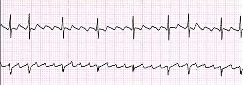 Flutter atrial