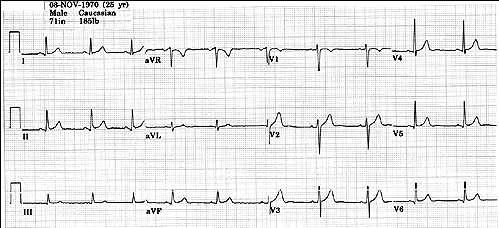 ECG