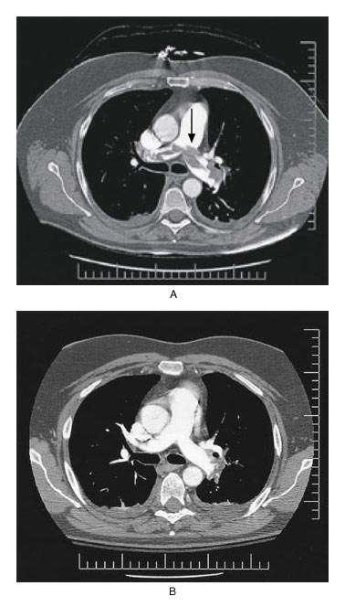 Angiotomografia de tórax Homem de 52 anos apresentando quadro clínico compatível com TEP. Angiotomografia de tórax inicial evidenciando êmbolo em bifurçação de a.