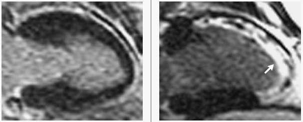 Miocardiopatia Tako-Tsubo RNM: Ausência de realce tardio ajuda