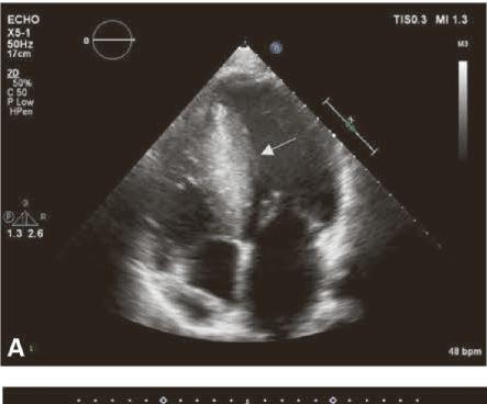 Papel do Ecocadiograma: - Miocardiopatias -