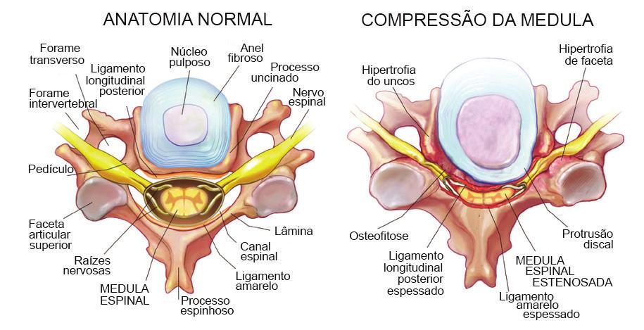 medula espinal, e o termo espondilose refere-se à lesão degenerativa ou desgaste das articulações entre as vértebras.