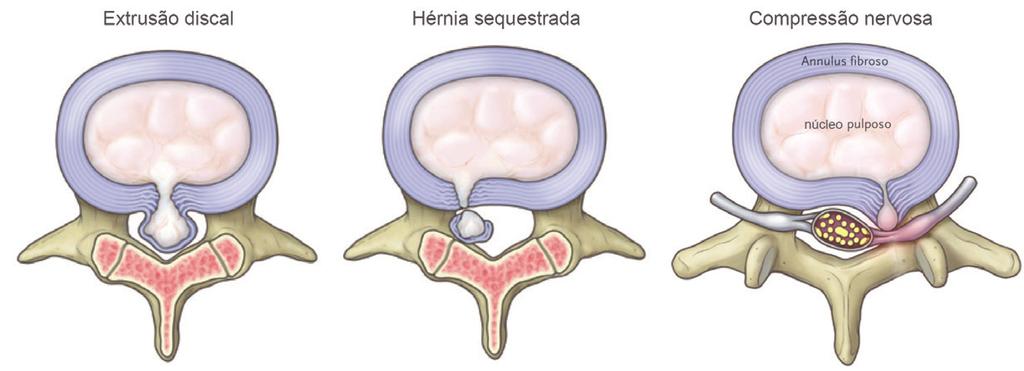 PATOLOGIAS DEGENERATIVAS Os principais sintomas da hérnia discal estão relacionados com a sua localização e podem ser citados os quadros abaixo: Radiculopatia: dor irradiada para membros (braços, nos