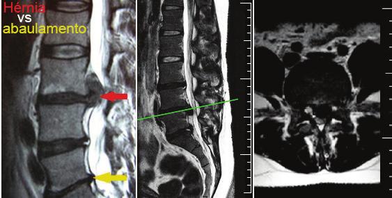 Síndrome da cauda equina: quadro grave de anestesia em sela com alterações esfincterianas, como incontinência fecal ou urinária. Grande hérnia lombar, normalmente central, no nível de L4-L5.