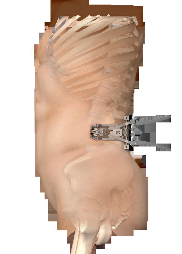 O XLIF não requer uma exposição anterior (frontal) ou posterior (costas) e, portanto, não apresenta os mesmos riscos de lesão vascular e / ou neural como Quais são os potenciais benefícios de um XLIF?