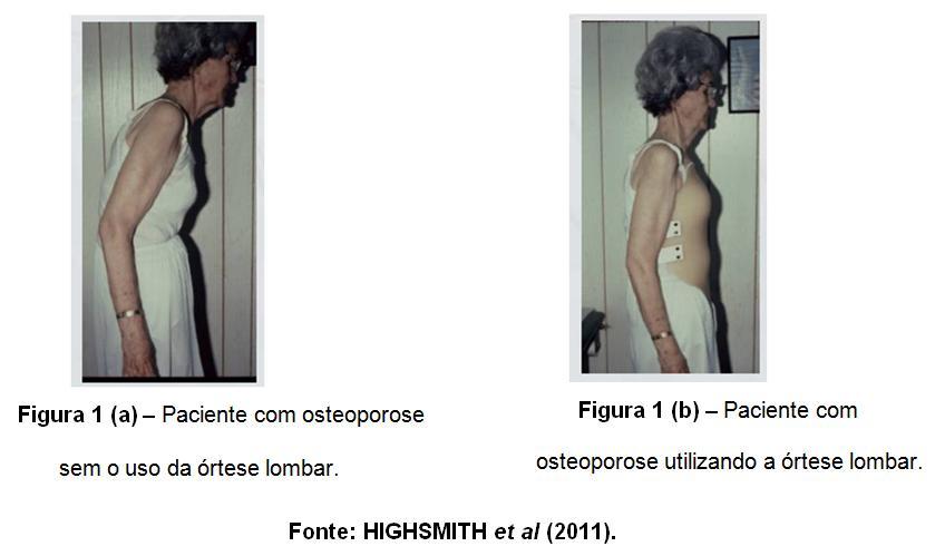 fratura varia de acordo com as características da estrutura, do conteúdo mineral e da qualidade do osso. (NATOUR, 2010).