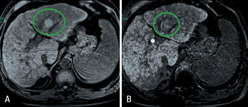 T1 - Hipossinal; T2 - Hipersinal