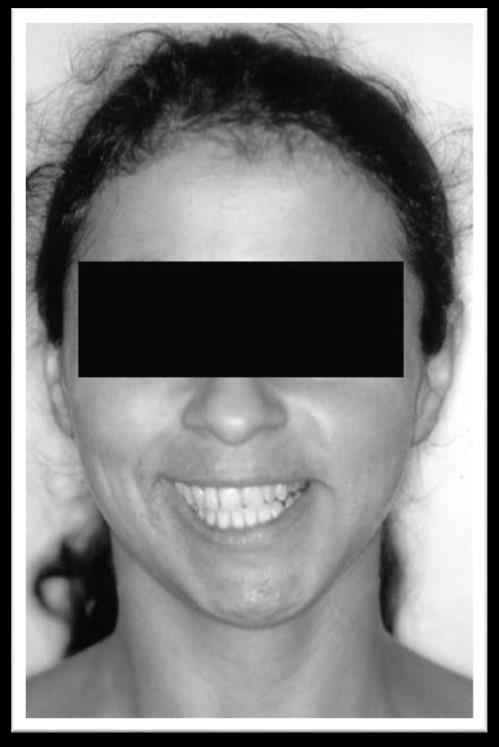 Deve-se fazer diagnóstico diferencial entre as assimetrias verdadeiras e as assimetrias aparentes, com o recurso a radiografias como a ortopantomografia e telerradiografia frontal da face.