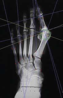 Hálux valgo em homens: demografia, etiologia e radiologia comparativas Figura 1 - Radiografias em AP e perfil do pé direito de paciente do sexo masculino.