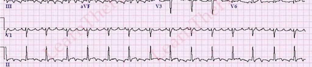 3 Frequência cardíaca? Existem ondas p? QRS estreitos ou alargados?