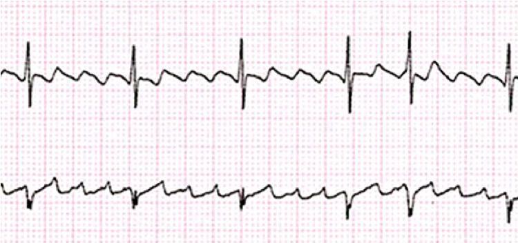 TAQUIARRITMIAS Flutter auricular Principais tipos de disritmias Fibrilhação auricular Mecanismo: circuito de