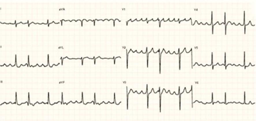 TAQUIARRITMIAS Flutter auricular Principais tipos de disritmias Fluter auricular Ritmo