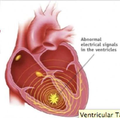 do ECG: - 3 complexos QRS alargados, habitualmente com morfologia à do ECG basal - ritmo regular - FC > 120bpm Ritmo