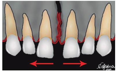 Figura 6 - Alterações de forma dos incisivos laterais superiores (dente conoide/microdente).