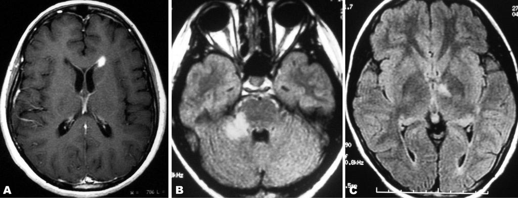 Abnormal brain MRI in patients with neuromyelitis optica. (A) Isolated gadolinium-enhancing periventricular lesion.
