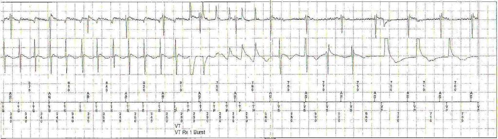 Fig. 4 EGM gravado do CDI (paciente 68) demonstrando reversão de TV através de ATP