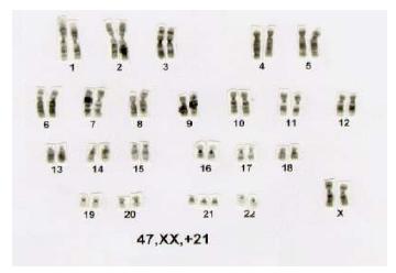 Normal Cromossomo 13 (azul) e 21