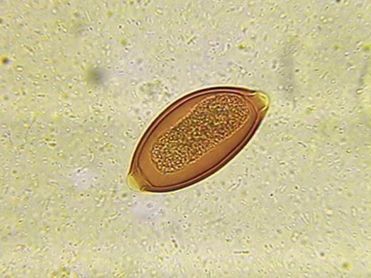 Espaços císticos contendo material necrótico, grande quantidade de eosinofilos, neutrófilos, linfócitos são observados em nível