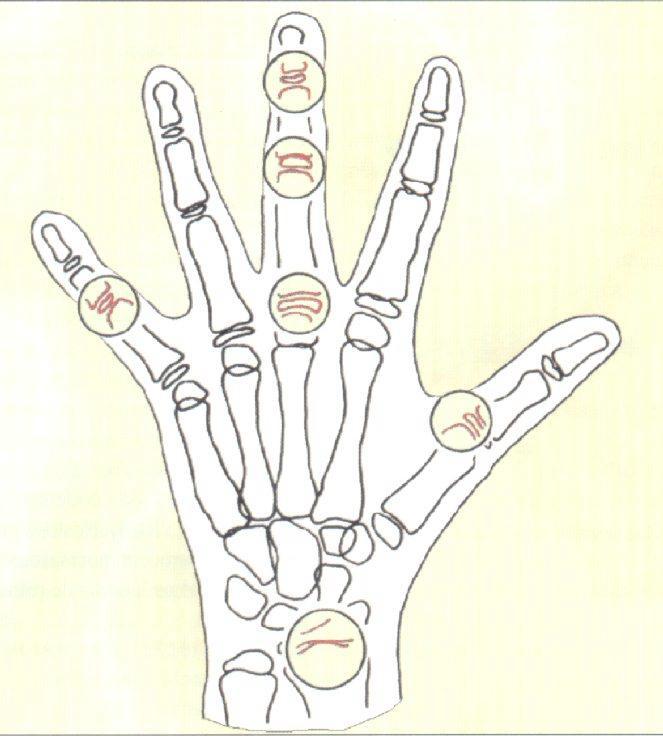 sistema estava baseado em 4 estágios de maturação óssea onde, todos são encontrados em 6 sítios anatômicos: polegar (falange proximal), 3 dedo (falange proximal, média e distal), 5 dedo (falange