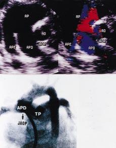 Soares e cols Arq Bras Cardiol arterial variou de 10 a 22mm. Circulação extracorpórea (CEC) e hipotermia foram usados em todos os pacientes.