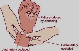 Teste de Allen - Oclui-se a artéria radial e ulnar; - Pede ao paciente que abra e feche a mão, nos pacientes inconscientes faz-se o