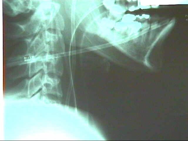 Oximetria de bulbo jugular Determinar a SjO 2 Método