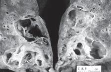 Figura 4 Radiografia em PA Evolução ambulatorial: aumento do nível hidroaéreo da imagem de hipertransparência anular.
