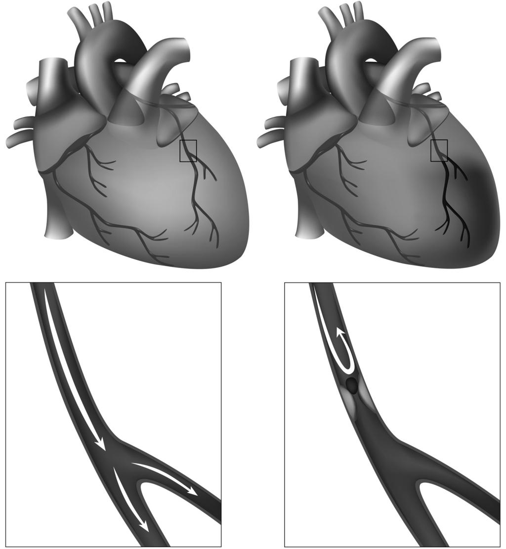 O QUE É 2 INFARTO AGUDO DO MIOCÁRDIO Quando uma artéria coronária (que fornece o suprimento sanguíneo ao músculo cardíaco) é obstruída, a parte do coração por ela irrigada sofre isquemia, que é a