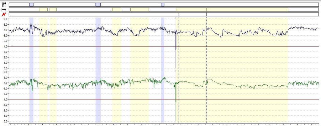 Ausência de refluxo gastroesofágico ácido proximal e distal phmetria por cápsula Colocada via endoscopia a 6 cm acima da transição esofagogástrica. Pelo maior conforto permite a avaliação por 48hs.