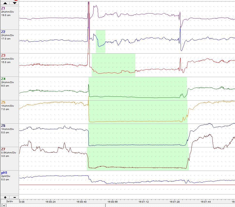 Refluxo levemente ácido. Observe a queda do ph porém não abaixo de 4.