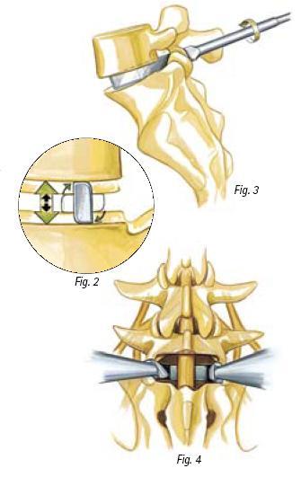 A fusão óssea entre a vértebra e o implante é alcançada dessa forma. A função principal do implante PROSPACE é restabelecer a altura dos discos intervertebrais após a eliminação de sua substância.