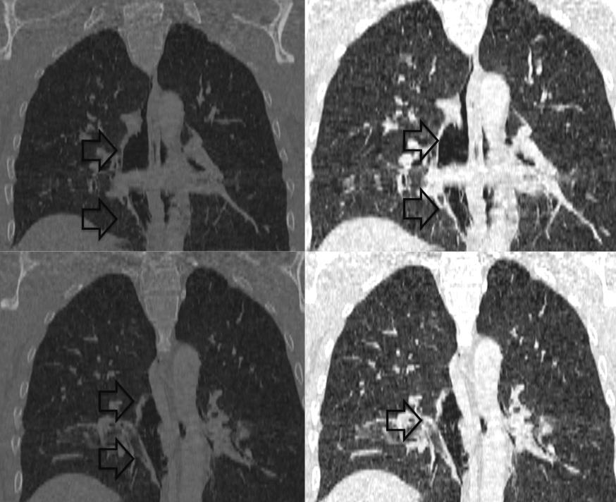 Figura 2 - Aquisições coronais antes e após a infusão de meio de contraste endovenoso e com janela para mediastino e pulmão, onde observamos (setas) pneumomediastino dissecando a aorta e o esôfago.