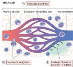 Alterações vasculares Edema Infiltrado