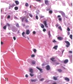 tuberculosis Mycobacterium leprae Sinais flogísticos 22 Inflamação aguda x crônica 23 Características Insidiosa e de