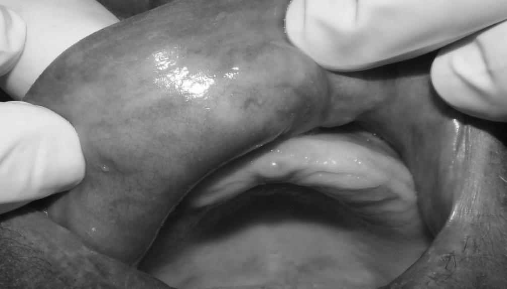 Figura 2: Lesões em lábio superior, sem sintomatologia dolorosa, firmes à palpação, com leve flutuação, de tamanhos de 5mm e 3cm.