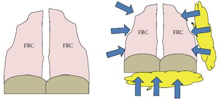 OBESIDADE E VOLUMES PULMONARES Efeito principal em volumes pulmonares, sem efeito direto sobre os fluxos. VR e VR/CPT Normais Salome MS, et al. J Appl Physiol. 2010; 108:206-21.