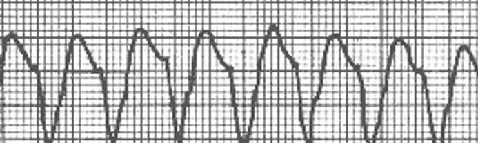 11 Atividade Elétrica sem Pulso (AESP): parada súbita do coração como bomba mantendo ritmo elétrico, porém sem contração ventricular; Causas Reversíveis - Hipovolemia - Tensão do tórax por