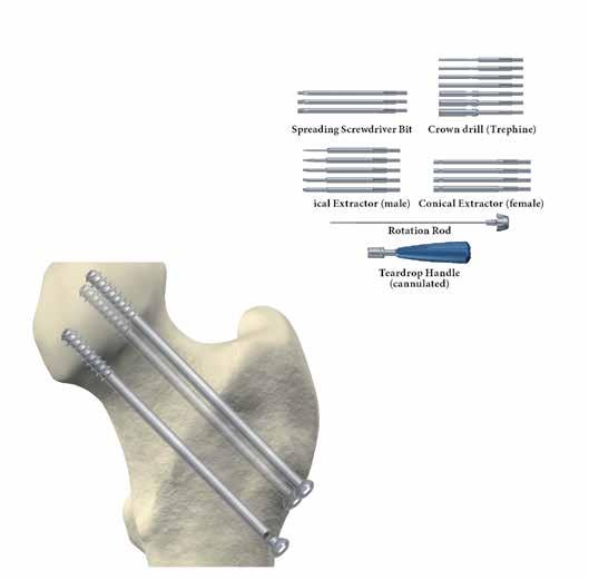 Ponta de chave de parafusos extensora Broca de coroa (trefina) Extractor cónico Extractor cónico (fêmea) (macho) Haste de rotação Punho em forma de gota (canulado) Se não conseguir remover o parafuso