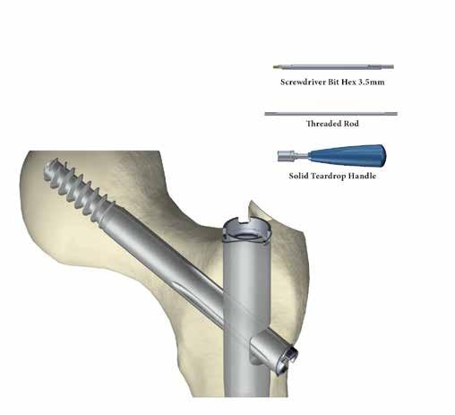 Técnica cirúrgica Parafusos cefálicos É realizada uma incisão sobre a extremidade proximal da cavilha.