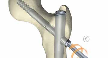 Técnica cirúrgica Técnica cirúrgica Conjunto de extracção de implantes Verifique se o crescimento ósseo não obstrui o encaixe seguro do dispositivo de extracção; caso contrário, o implante ou o