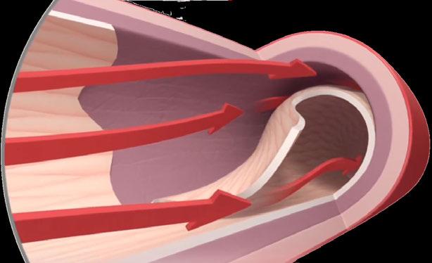 Definição Separação das camadas da aorta com