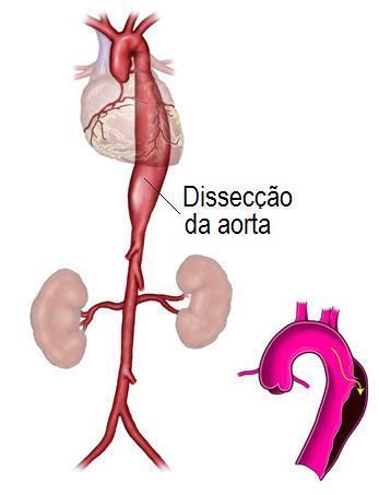 ARTÉRIA AORTA E GRANDES RAMOS São artérias elásticas constituídas pela túnica íntima, média e adventícia.