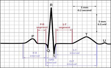 A RELAÇÃO ENTRE O ELETROCARDIOGRAMA E O CICLO CARDÍACO O eletrocardiograma, demonstrado esquematicamente na figura, mostra as ondas P, Q, R, S e T.