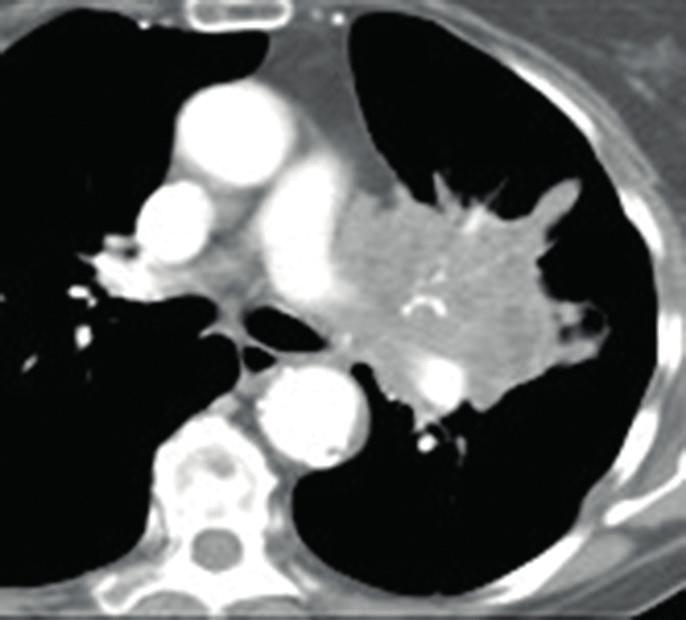 LINFONODOS (Q): Qual N deve ser atribuído quando um câncer de pulmão invade o hilo ou o mediastino, mas nenhum linfonodo pode ser identificado (Figura 13)?