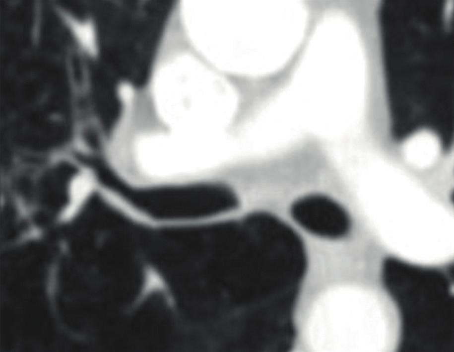 O uso da PET-CT ou do mapa de difusão pela RM pode ser útil na definição do T, mesmo nas lesões rodeadas por consolidação ou atelectasia, e deve ser considerado quando clinicamente relevante (ver