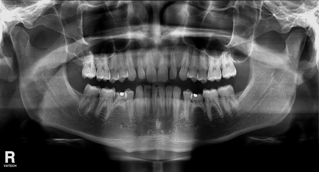 3. A distância entre o primeiro molar permanente e o primeiro pré-molar permanente ou o primeiro molar decíduo, utilizando uma