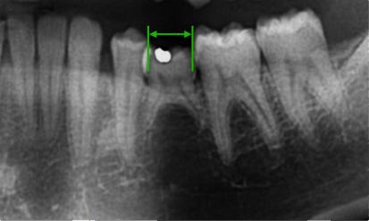 Figura 4 Distancia entre o primeiro molar permanente e o primeiro molar decíduo ou primeiro pré-molar permanente. 4. A distância mesio-distal do segundo molar decíduo utilizando uma régua milimétrica (largura X).