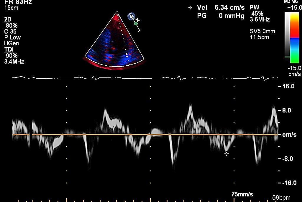 Onda e lateral do Doppler tecidual = 6,34 cm/s