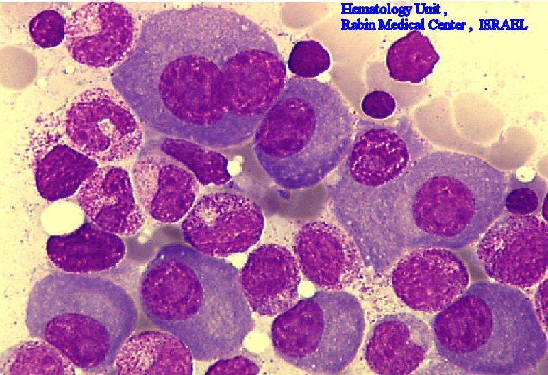 Critérios diagnósticos MM Mieloma: Diagnóstico 1- > 10% de plasmócitos na medula óssea (ou em tecido infiltrado); 2- Proteina monoclonal M no soro ou urina; 3- Evidência de lesão de orgão alvo :