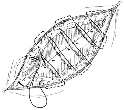 SUTURA DO SUBCUTÂNEO (similar à de Cushing) 12.